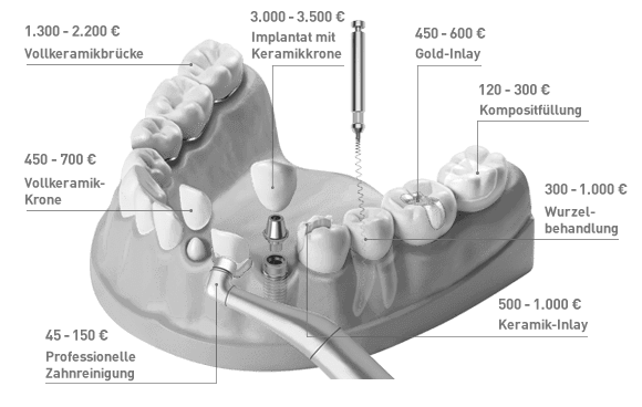 Kostenbeispiele Zahnarzt